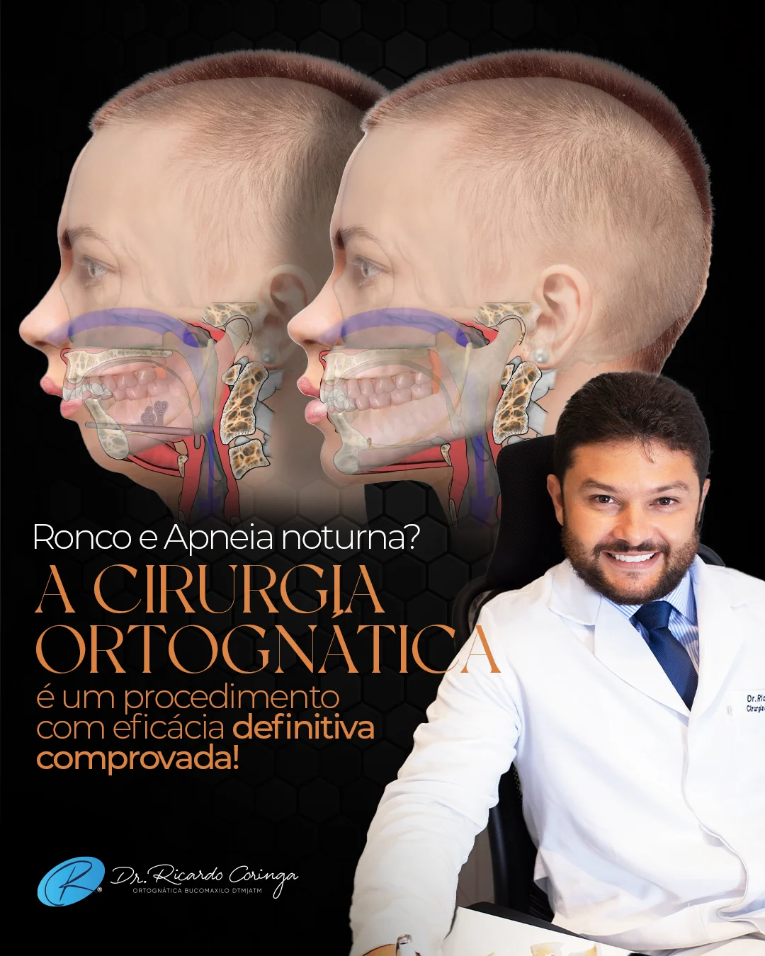 Apneia Obstrutiva do Sono: Como a Cirurgia Bucomaxilofacial Pode Proporcionar uma Solução Definitiva