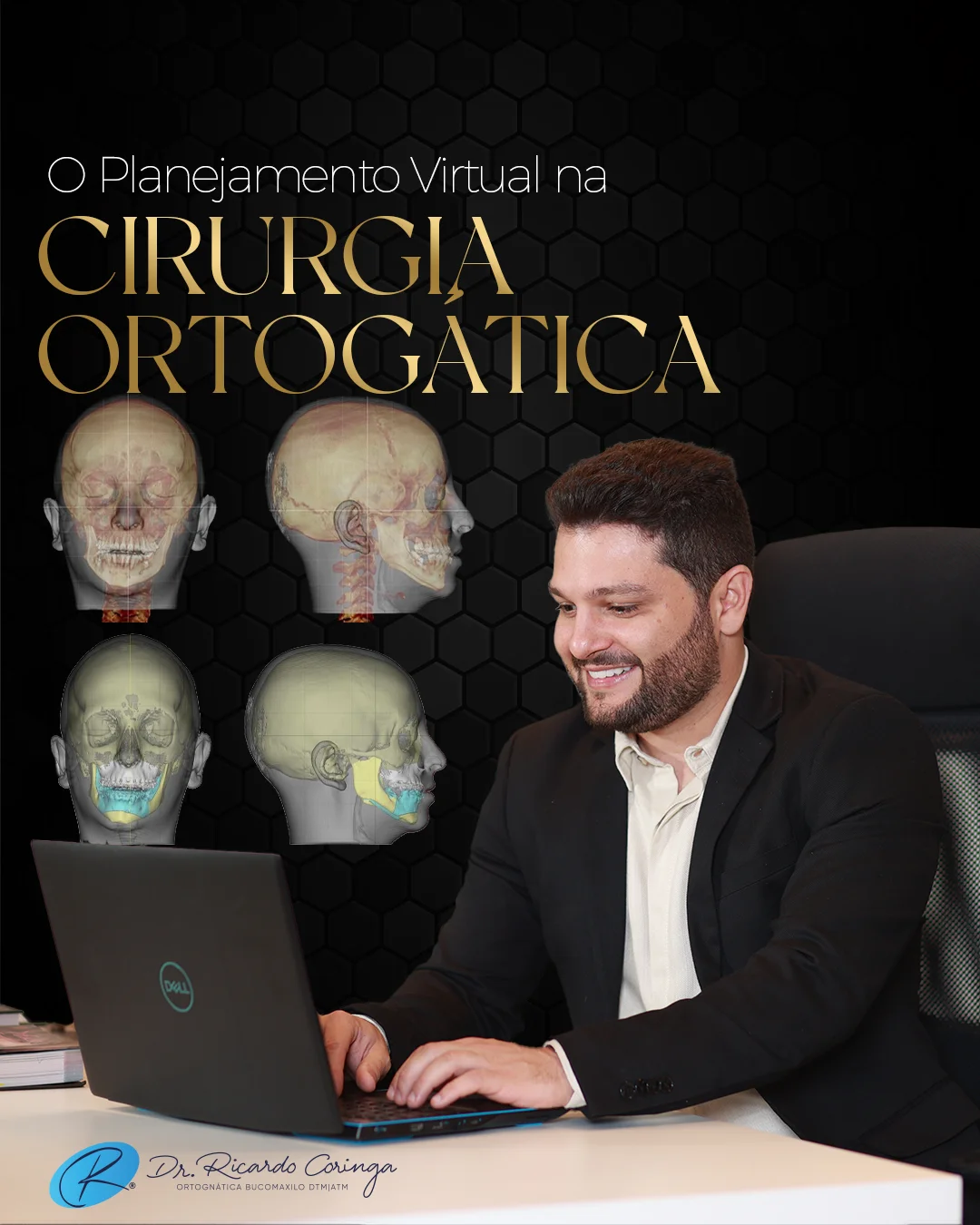Inteligência Artificial na Cirurgia Bucomaxilofacial: o futuro já chegou aos centros cirúrgicos