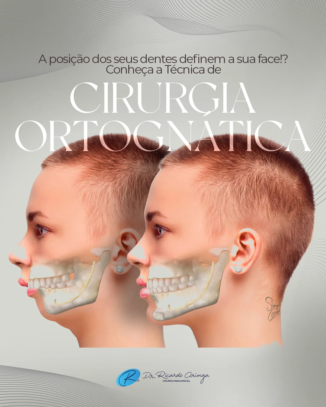 Cirurgia Ortognática: O papel do planejamento virtual 3D