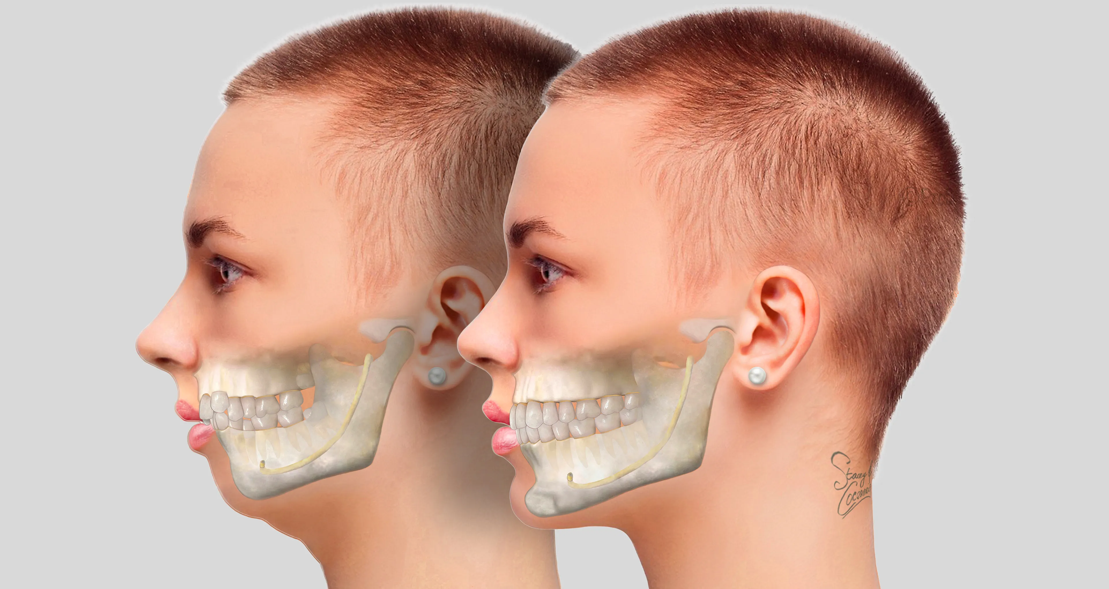 Cirurgia Ortognática