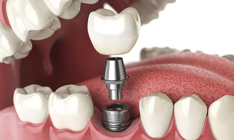 Implantes Dentários